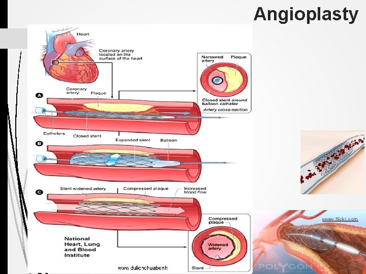 Angioplasty www. flickr. com 