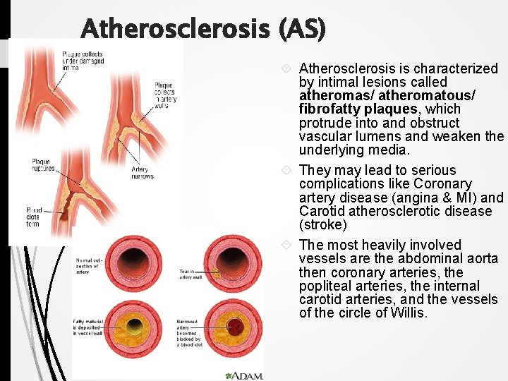 Atherosclerosis (AS) Atherosclerosis is characterized by intimal lesions called atheromas/ atheromatous/ fibrofatty plaques, which