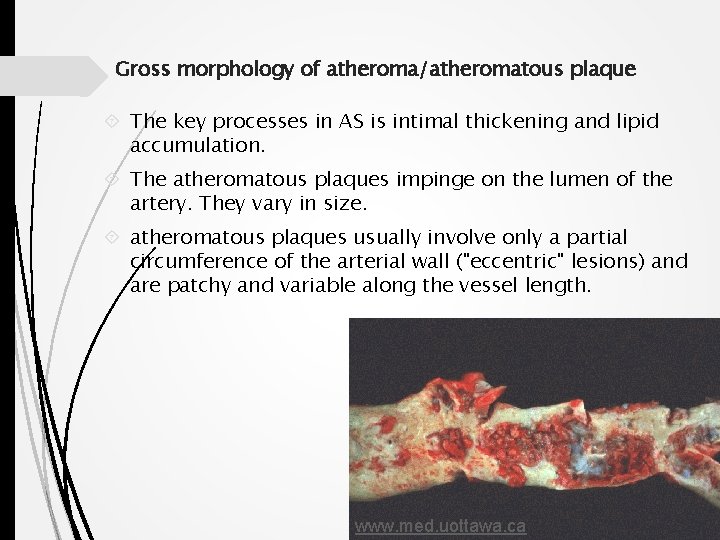 Gross morphology of atheroma/atheromatous plaque The key processes in AS is intimal thickening and