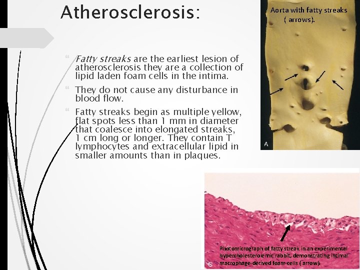 Atherosclerosis: Aorta with fatty streaks ( arrows). Fatty streaks are the earliest lesion of