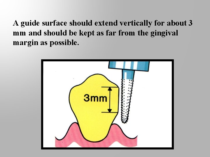 A guide surface should extend vertically for about 3 mm and should be kept