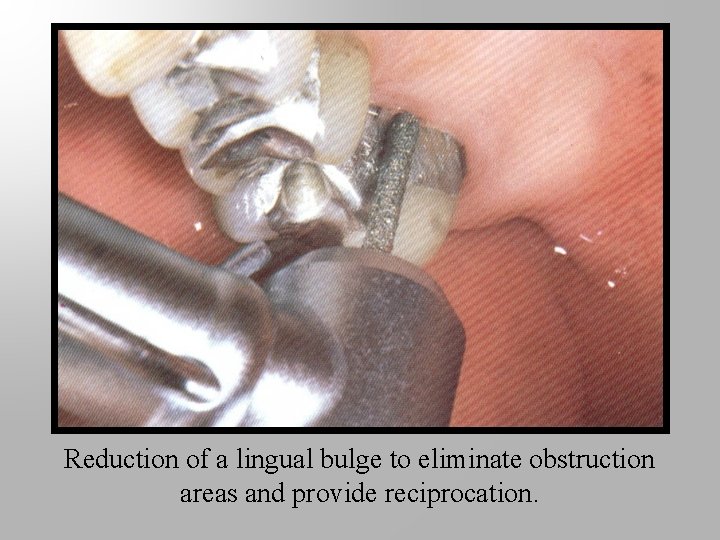 Reduction of a lingual bulge to eliminate obstruction areas and provide reciprocation. 