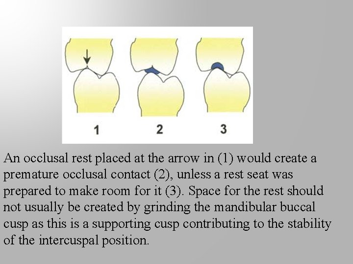 An occlusal rest placed at the arrow in (1) would create a premature occlusal