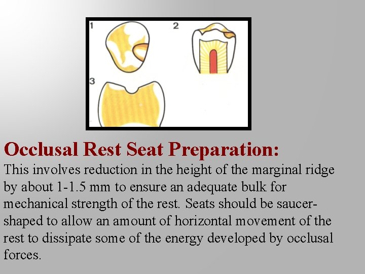 Occlusal Rest Seat Preparation: This involves reduction in the height of the marginal ridge