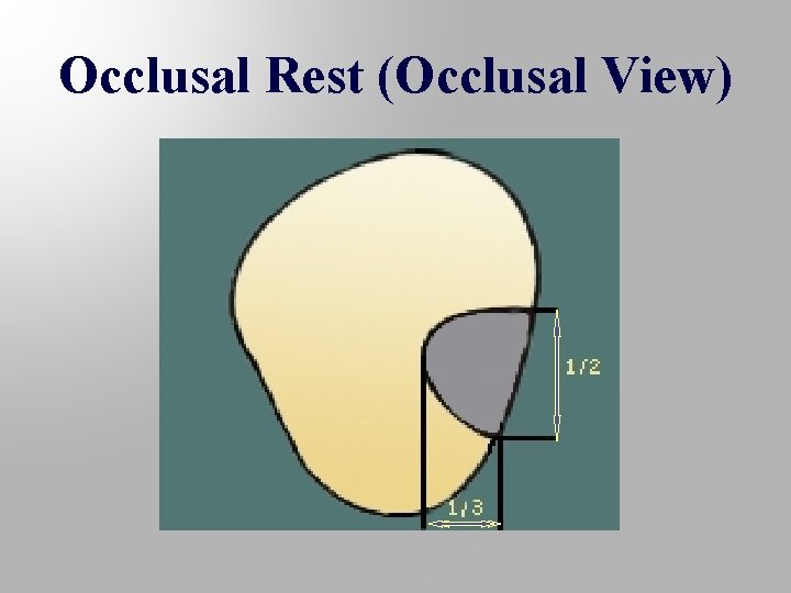 Occlusal Rest (Occlusal View) 
