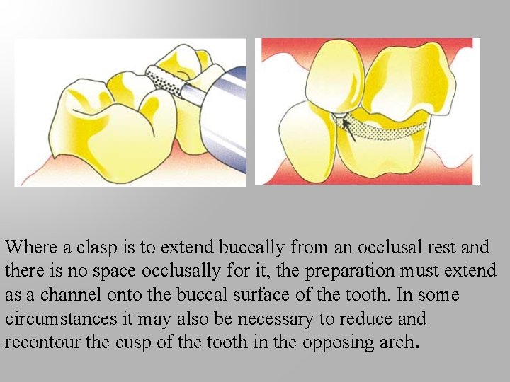 Where a clasp is to extend buccally from an occlusal rest and there is
