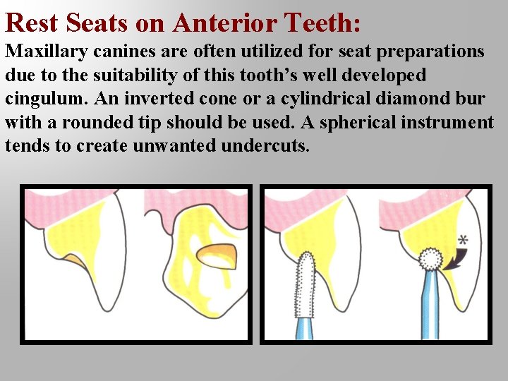 Rest Seats on Anterior Teeth: Maxillary canines are often utilized for seat preparations due