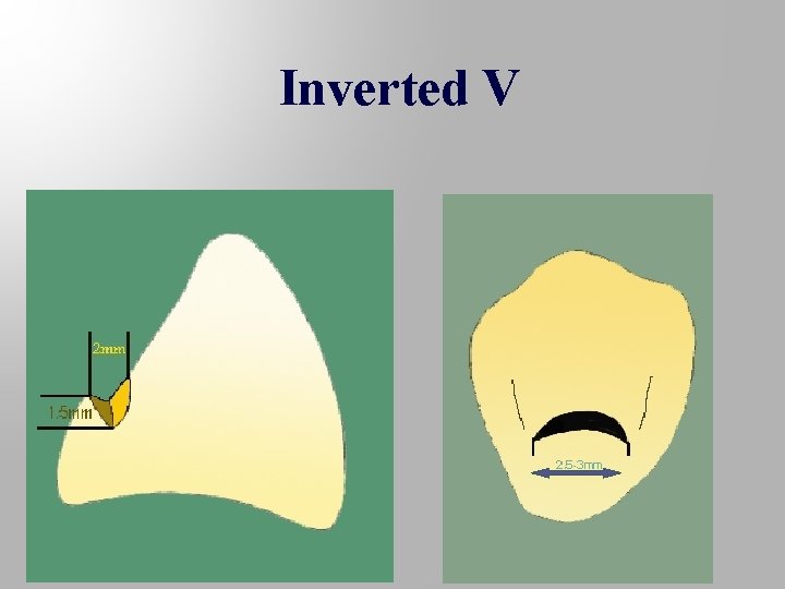Inverted V 