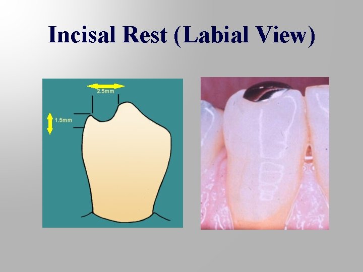 Incisal Rest (Labial View) 