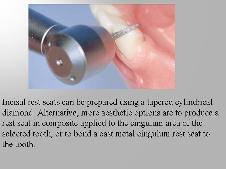 Incisal rest seats can be prepared using a tapered cylindrical diamond. Alternative, more aesthetic