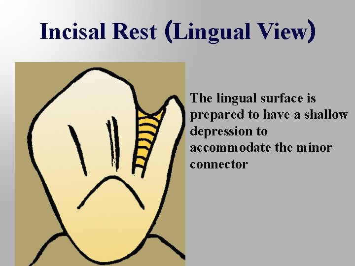 Incisal Rest (Lingual View) The lingual surface is prepared to have a shallow depression