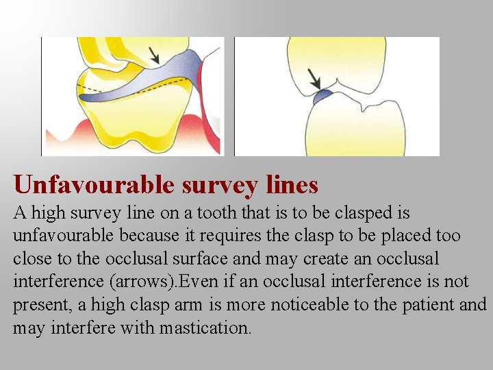 Unfavourable survey lines A high survey line on a tooth that is to be
