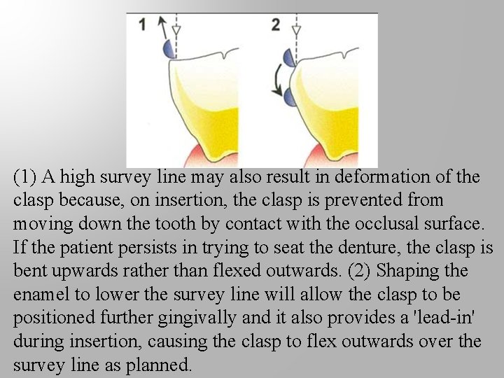 (1) A high survey line may also result in deformation of the clasp because,