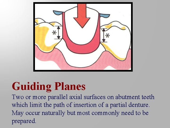 Guiding Planes Two or more parallel axial surfaces on abutment teeth which limit the