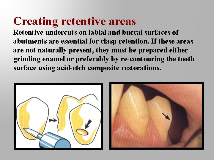 Creating retentive areas Retentive undercuts on labial and buccal surfaces of abutments are essential