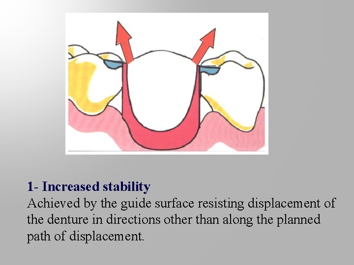 1 - Increased stability Achieved by the guide surface resisting displacement of the denture