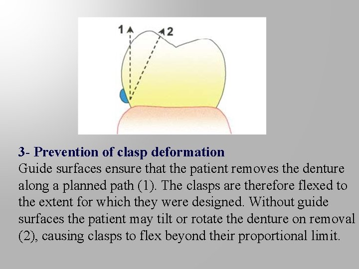 3 - Prevention of clasp deformation Guide surfaces ensure that the patient removes the