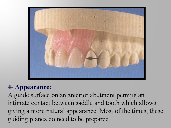 4 - Appearance: A guide surface on an anterior abutment permits an intimate contact