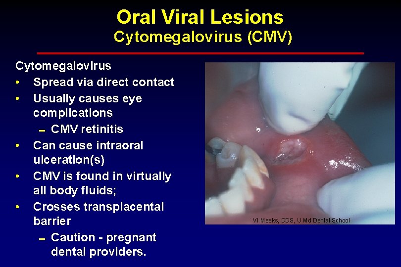 Oral Viral Lesions Cytomegalovirus (CMV) Cytomegalovirus • Spread via direct contact • Usually causes