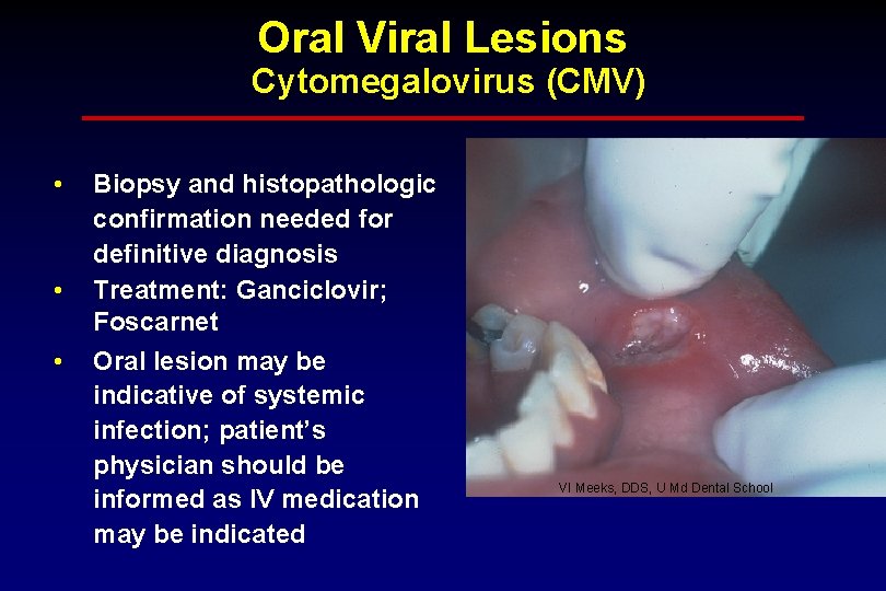 Oral Viral Lesions Cytomegalovirus (CMV) • • • Biopsy and histopathologic confirmation needed for