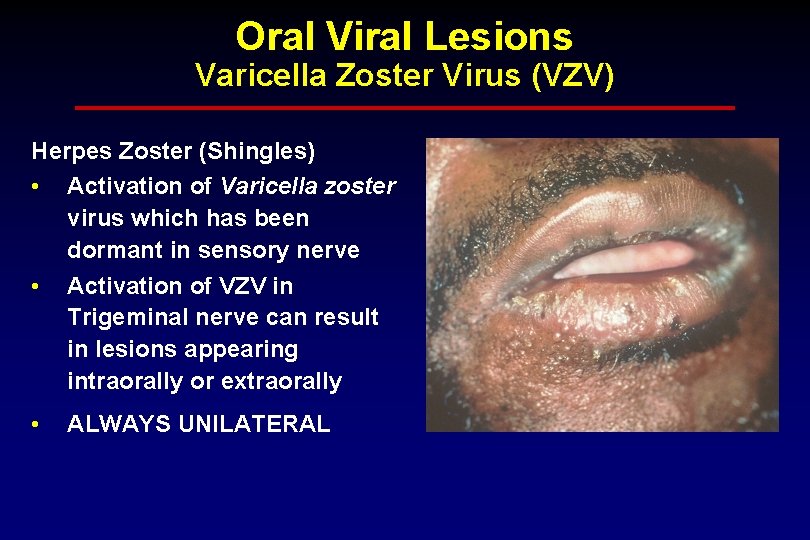 Oral Viral Lesions Varicella Zoster Virus (VZV) Herpes Zoster (Shingles) • Activation of Varicella