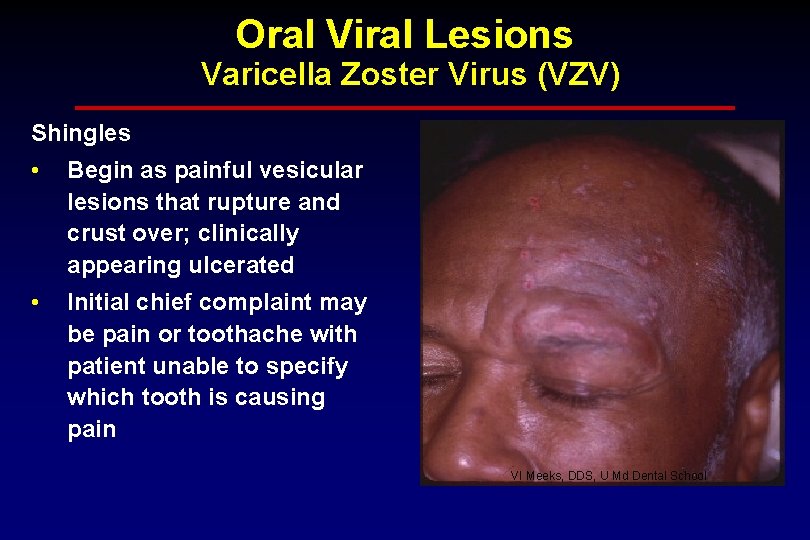 Oral Viral Lesions Varicella Zoster Virus (VZV) Shingles • Begin as painful vesicular lesions