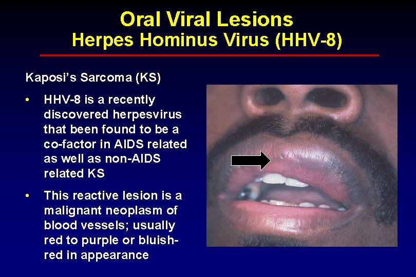 Oral Viral Lesions Herpes Hominus Virus (HHV-8) Kaposi’s Sarcoma (KS) • HHV-8 is a
