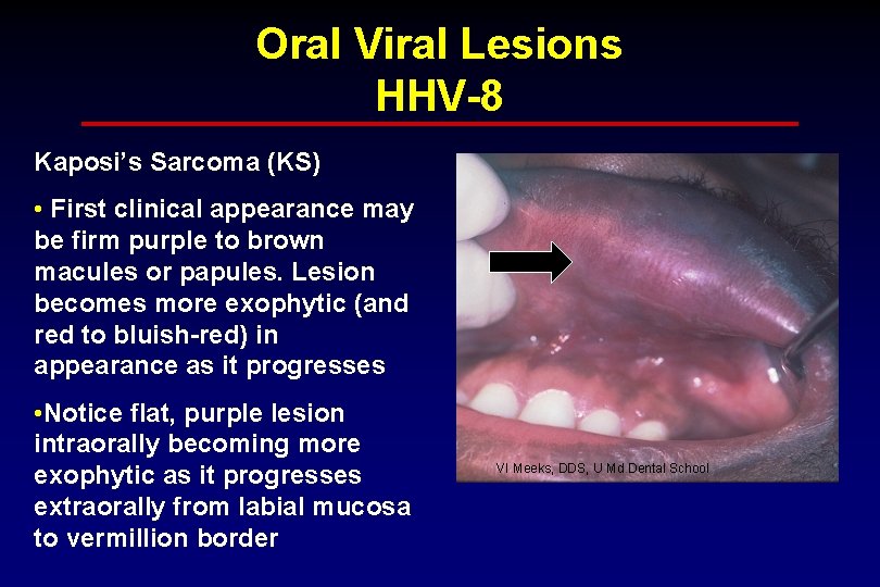 Oral Viral Lesions HHV-8 Kaposi’s Sarcoma (KS) • First clinical appearance may be firm