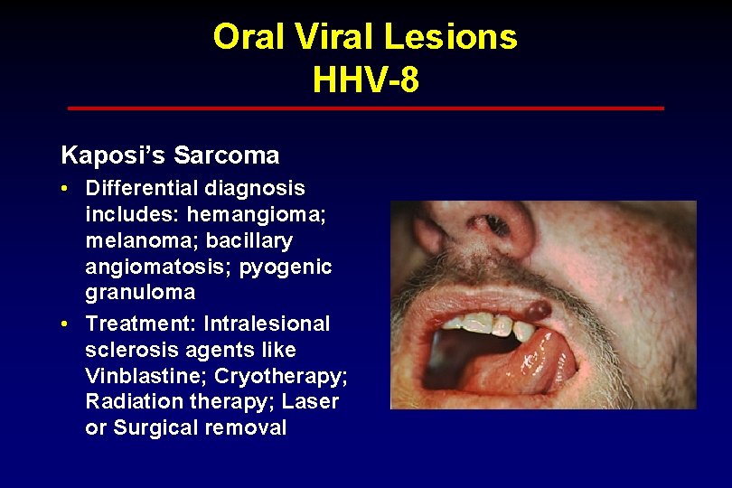 Oral Viral Lesions HHV-8 Kaposi’s Sarcoma • Differential diagnosis includes: hemangioma; melanoma; bacillary angiomatosis;