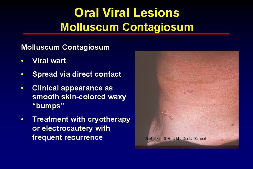 Oral Viral Lesions Molluscum Contagiosum • Viral wart • Spread via direct contact •