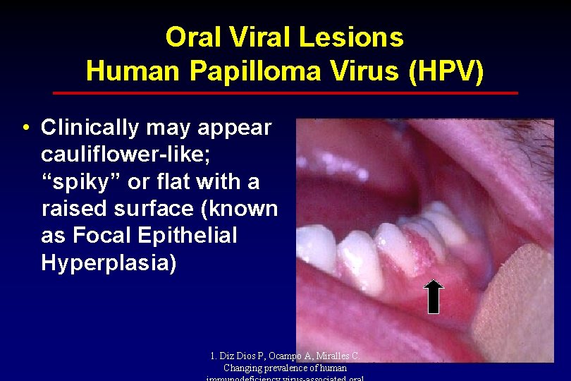 Oral Viral Lesions Human Papilloma Virus (HPV) • Clinically may appear cauliflower-like; “spiky” or