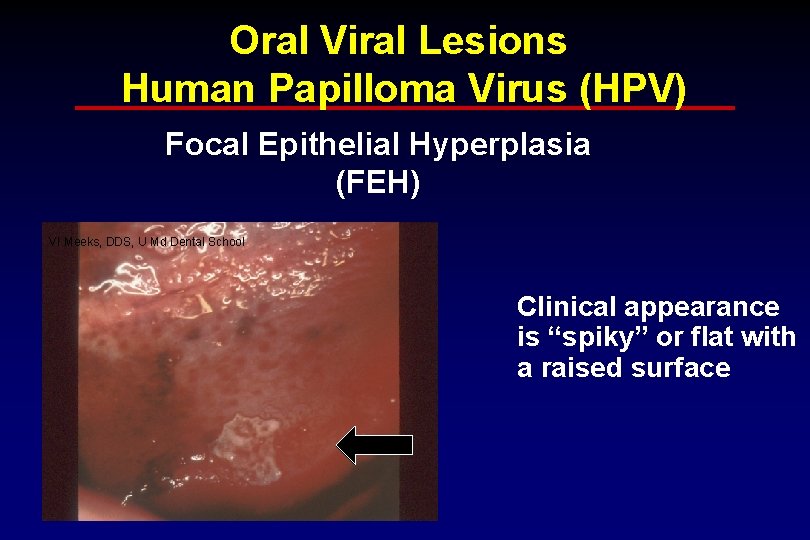 Oral Viral Lesions Human Papilloma Virus (HPV) Focal Epithelial Hyperplasia (FEH) VI Meeks, DDS,