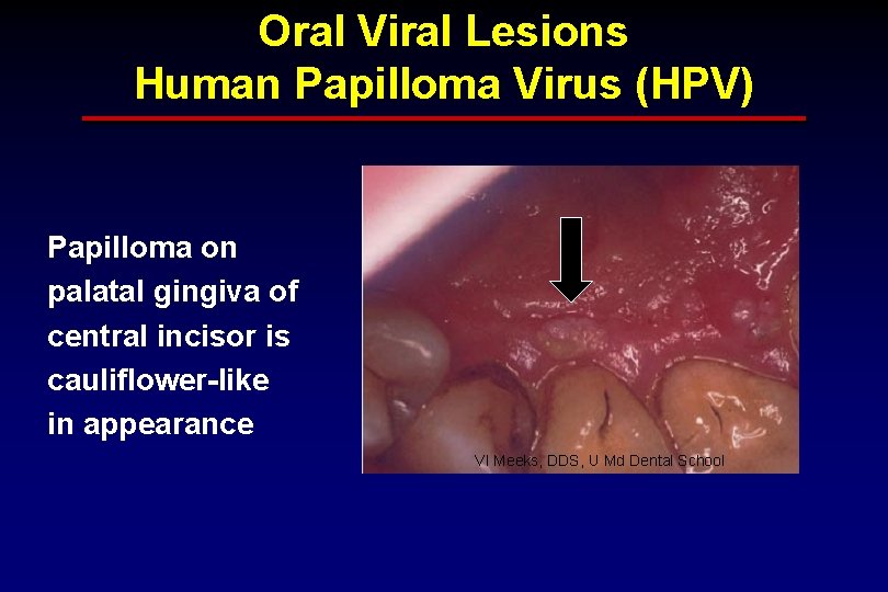 Oral Viral Lesions Human Papilloma Virus (HPV) Papilloma on palatal gingiva of central incisor