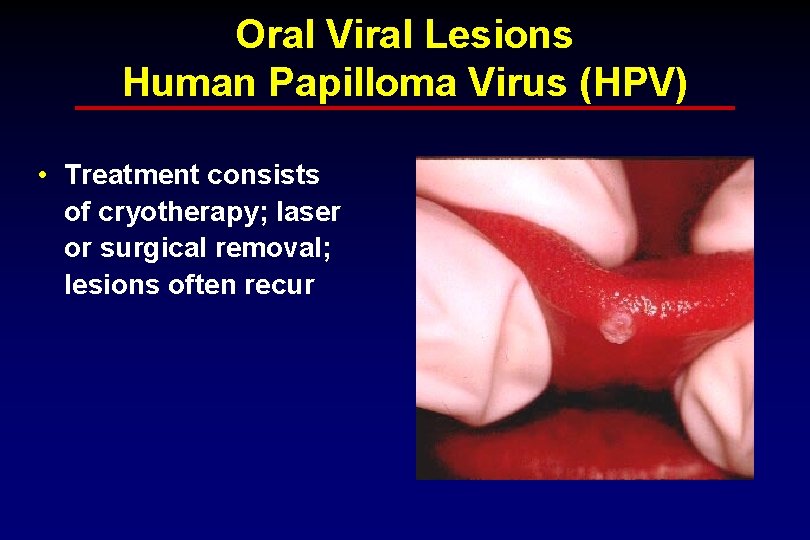 Oral Viral Lesions Human Papilloma Virus (HPV) • Treatment consists of cryotherapy; laser or