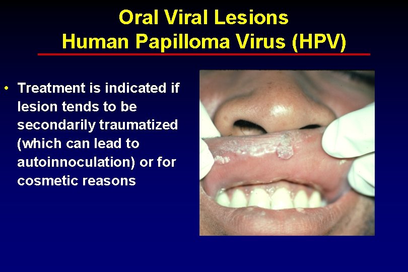 Oral Viral Lesions Human Papilloma Virus (HPV) • Treatment is indicated if lesion tends