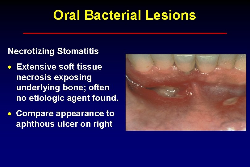 Oral Bacterial Lesions Necrotizing Stomatitis · Extensive soft tissue necrosis exposing underlying bone; often