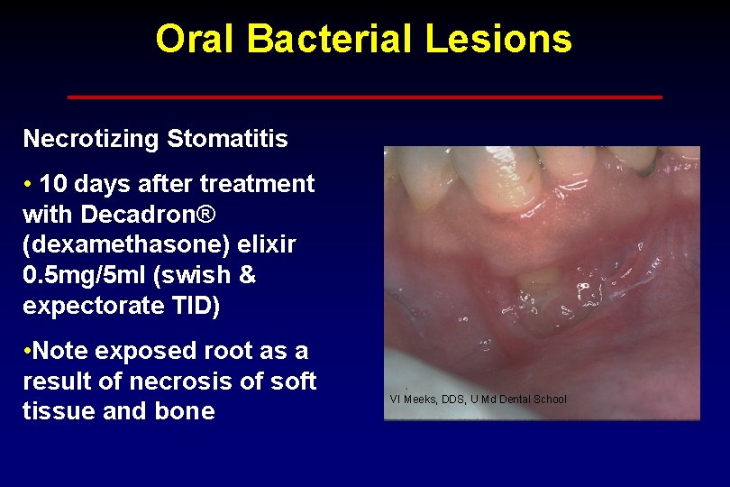 Oral Bacterial Lesions Necrotizing Stomatitis • 10 days after treatment with Decadron® (dexamethasone) elixir