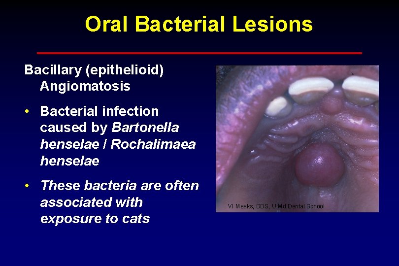 Oral Bacterial Lesions Bacillary (epithelioid) Angiomatosis • Bacterial infection caused by Bartonella henselae /