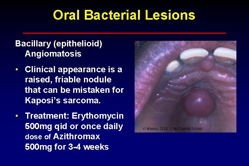 Oral Bacterial Lesions Bacillary (epithelioid) Angiomatosis • Clinical appearance is a raised, friable nodule