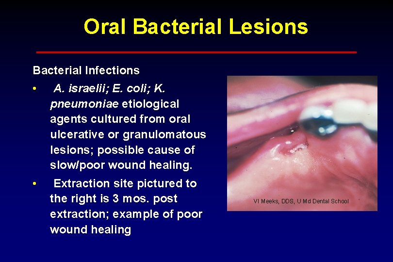 Oral Bacterial Lesions Bacterial Infections • A. israelii; E. coli; K. pneumoniae etiological agents