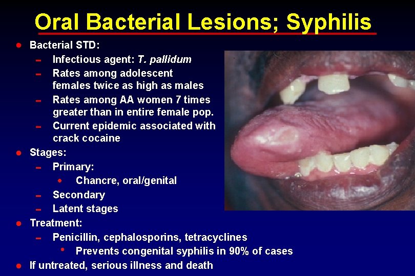 Oral Bacterial Lesions; Syphilis · Bacterial STD: 0 Infectious agent: T. pallidum 0 Rates