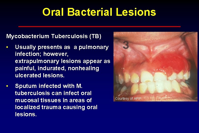 Oral Bacterial Lesions Mycobacterium Tuberculosis (TB) • Usually presents as a pulmonary infection; however,