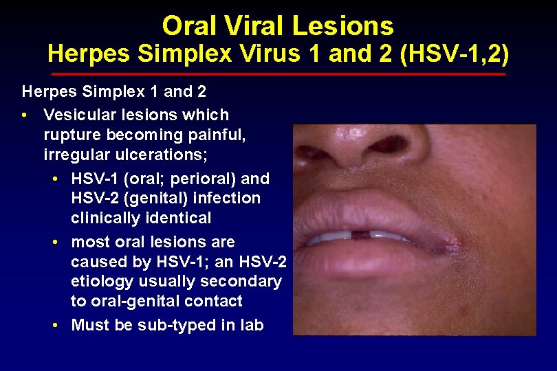 Oral Viral Lesions Herpes Simplex Virus 1 and 2 (HSV-1, 2) Herpes Simplex 1
