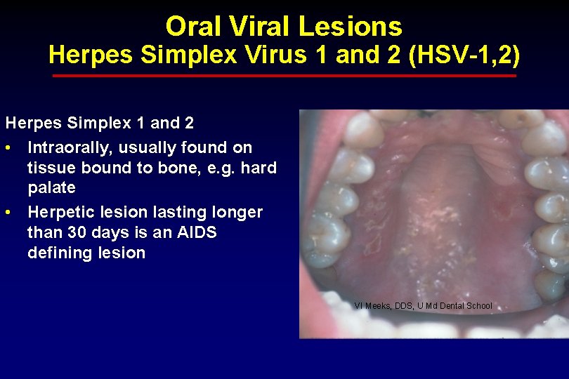 Oral Viral Lesions Herpes Simplex Virus 1 and 2 (HSV-1, 2) Herpes Simplex 1