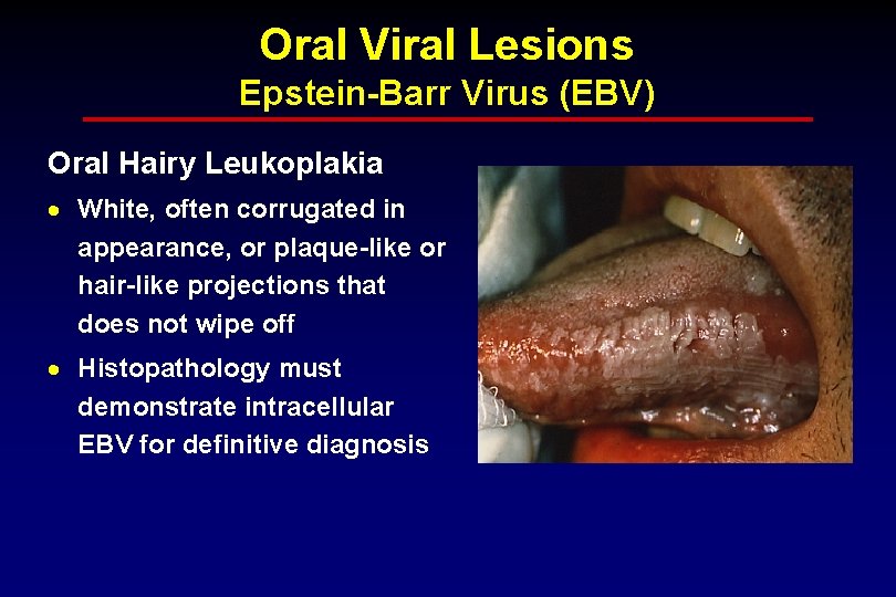 Oral Viral Lesions Epstein-Barr Virus (EBV) Oral Hairy Leukoplakia · White, often corrugated in