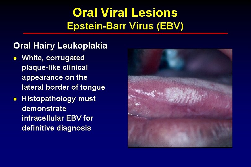 Oral Viral Lesions Epstein-Barr Virus (EBV) Oral Hairy Leukoplakia · White, corrugated plaque-like clinical