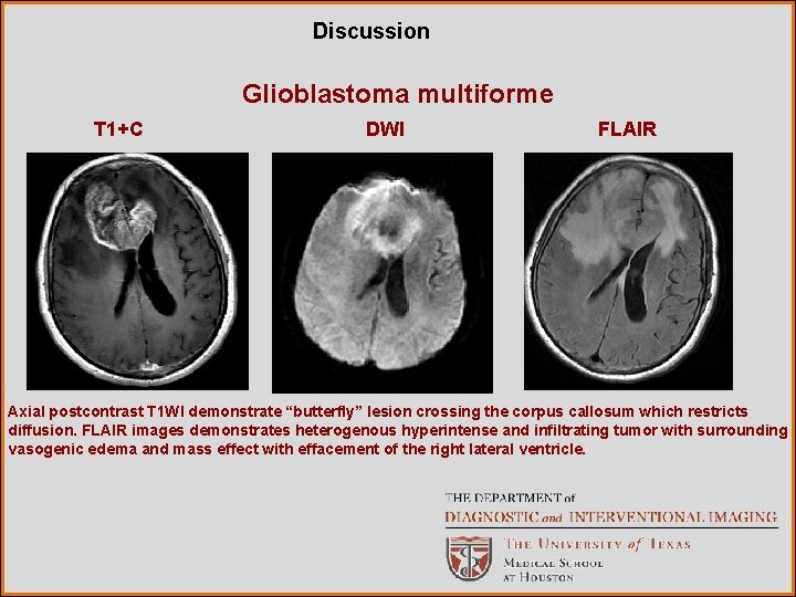 Discussion Glioblastoma multiforme T 1+C DWI FLAIR Axial postcontrast T 1 WI demonstrate “butterfly”