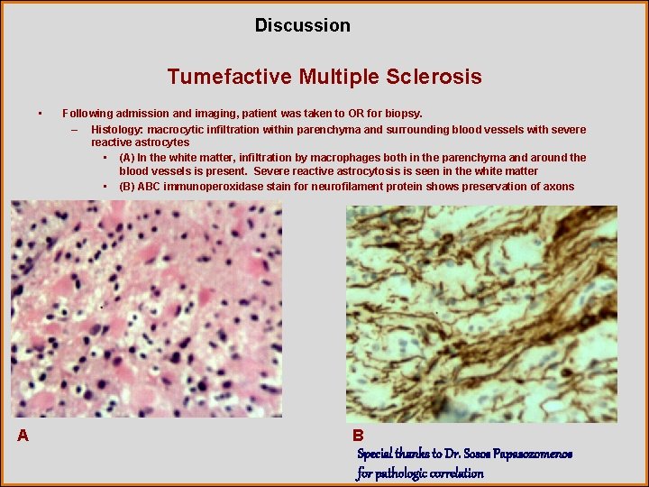 Discussion Tumefactive Multiple Sclerosis • A Following admission and imaging, patient was taken to