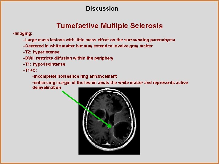 Discussion Tumefactive Multiple Sclerosis • Imaging: –Large mass lesions with little mass effect on