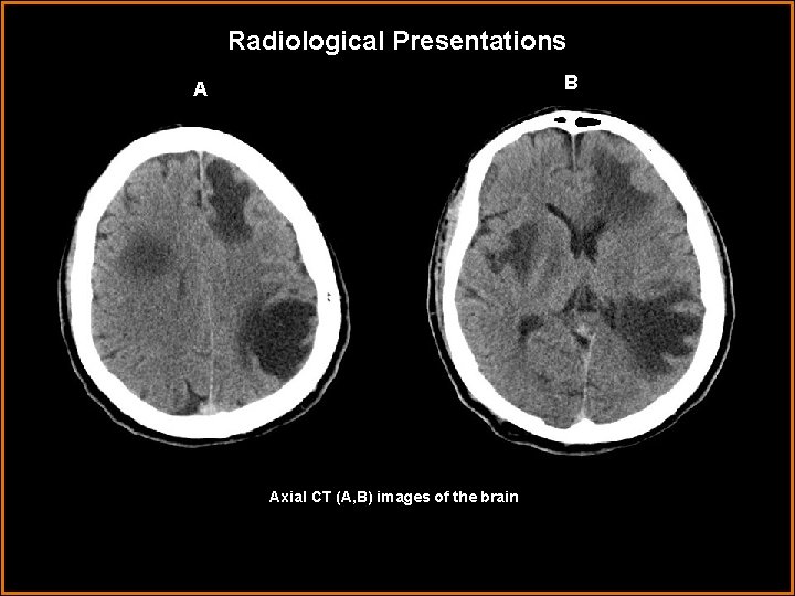 Radiological Presentations B A Axial CT (A, B) images of the brain 